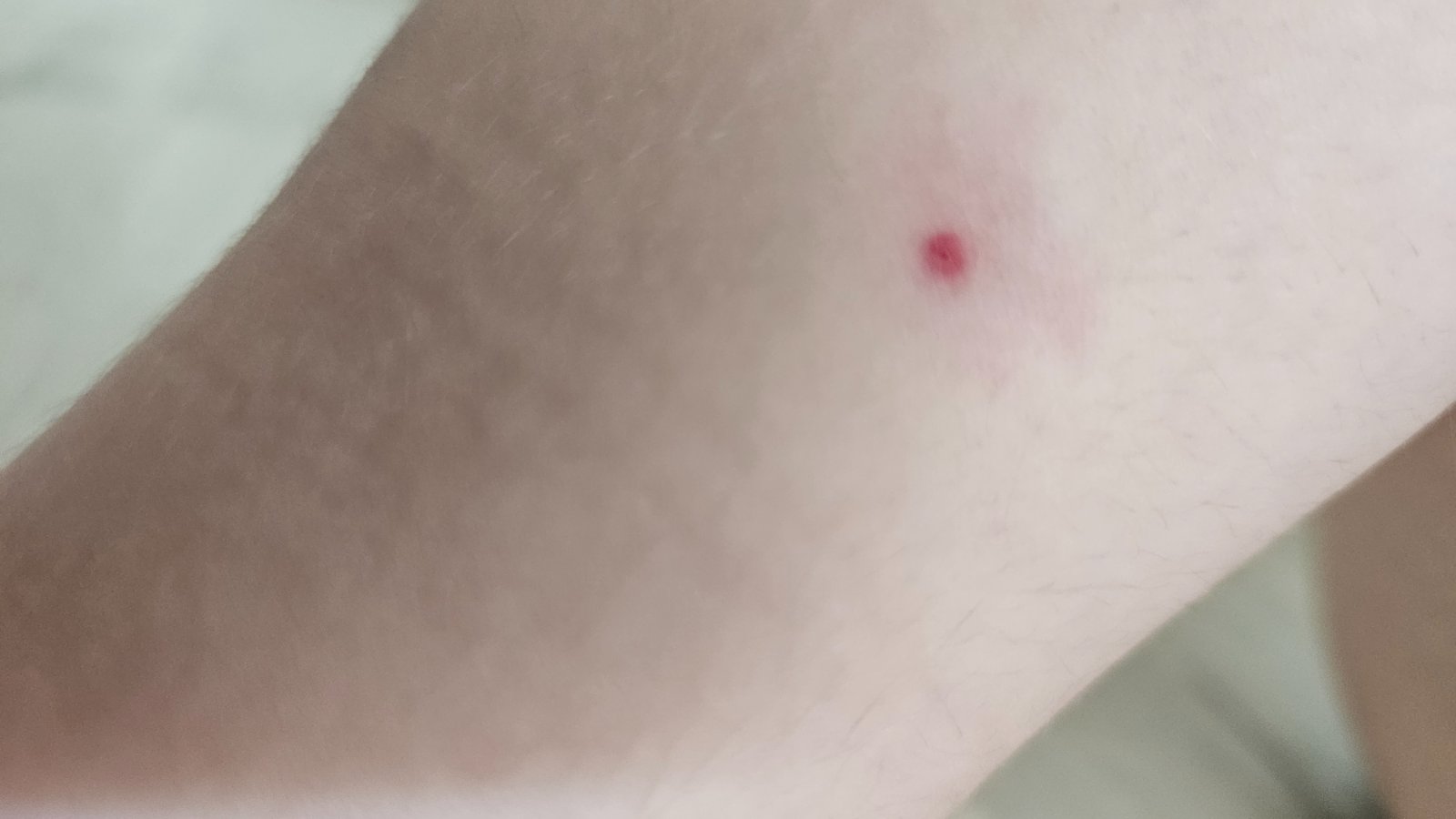 Je to štípanec alebo niečo vážnejšie? - Modrý koník