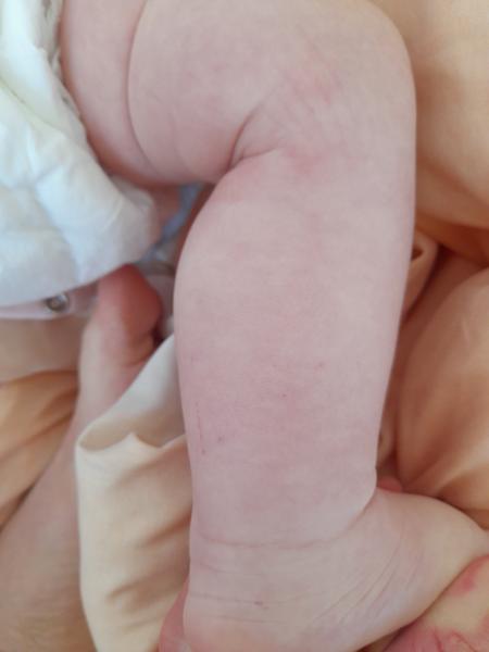 Petéchie u skoro štvormesačného bábätka