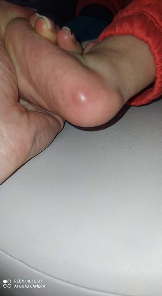 Aký kožný problém to má môj vnuk na chodidle?