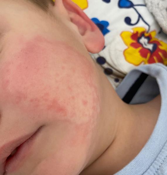 Čo spôsobuje výsev na lícach a rukách?