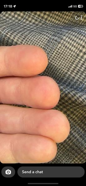 Fľaky na koncoch prstov: Čo môžu znamenať?