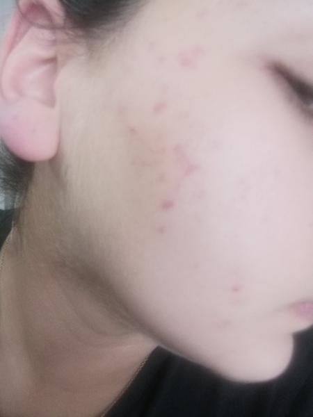 Ako účinne bojovať proti akné?