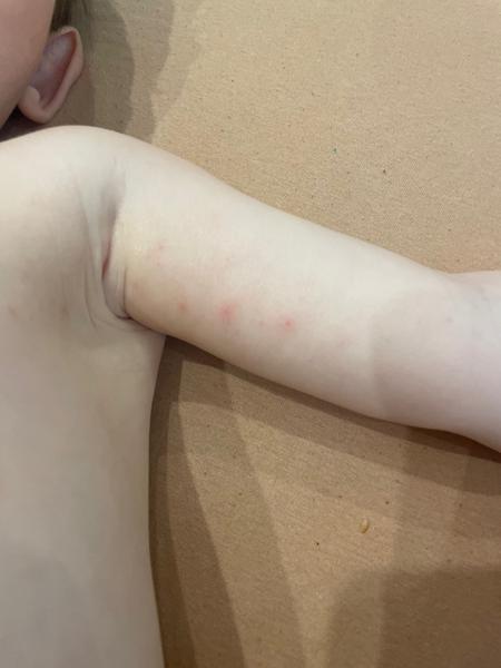 Výsyp u 19-mesačného dieťaťa