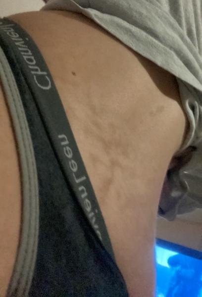 Čo sú tieto fľaky na chrbte?