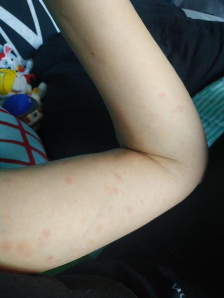 Z čoho mám červené vyrážky po tele?