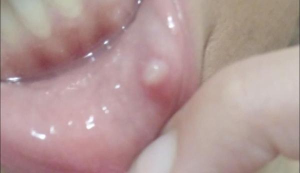 Guľka v ústnej dutine za perou: čo to môže byť?