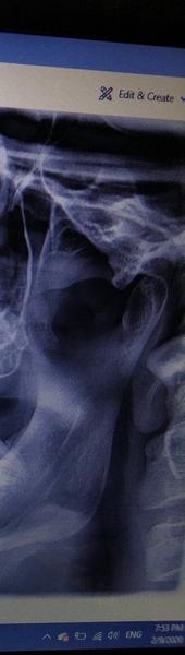 Je problém v čelustno - spánkovom kĺbe?