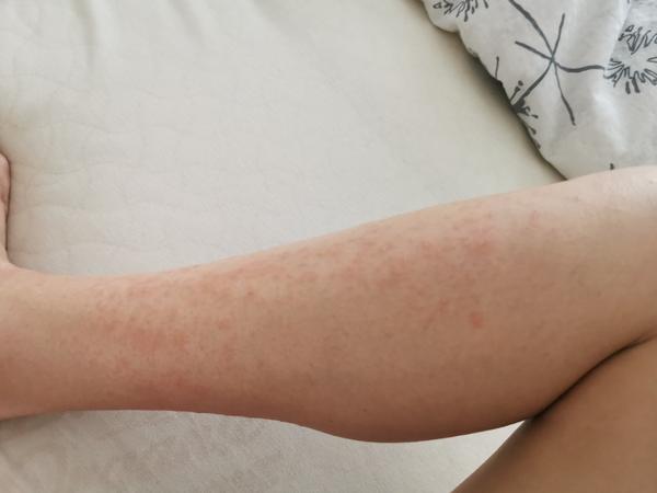 Aké vyrážky mám na nohách?