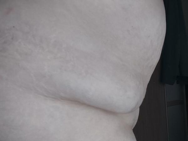 Môžem absolvovať ďalšiu abdominoplastiku?