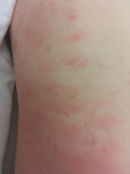 Dlhodobé vyrážky po chorobe u dieťaťa