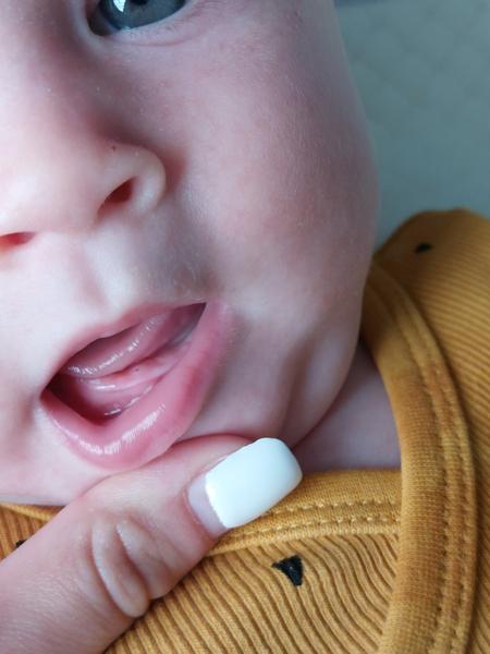 6-mesačná dcéra má opuch na ďasienku