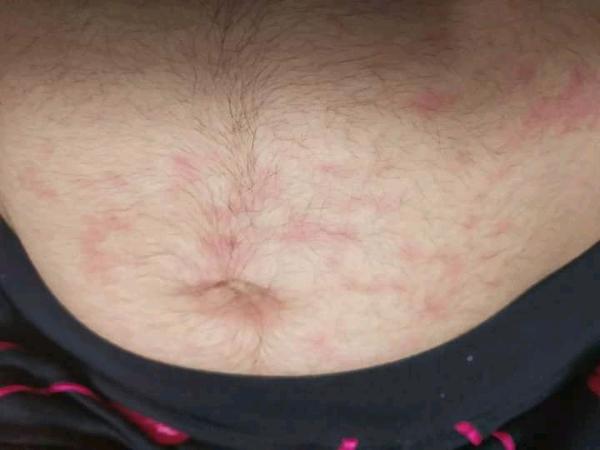 Začervenanie na bruchu a hnačka