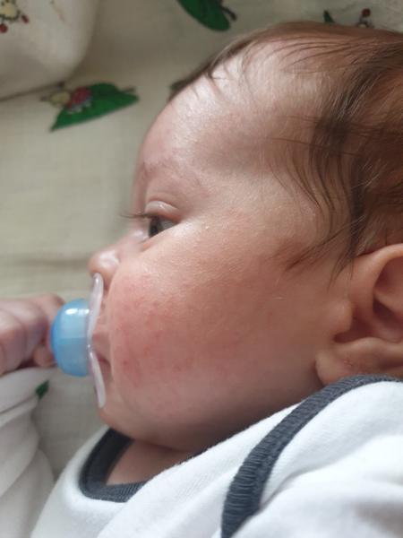 Červené pupáky na líčkach syna