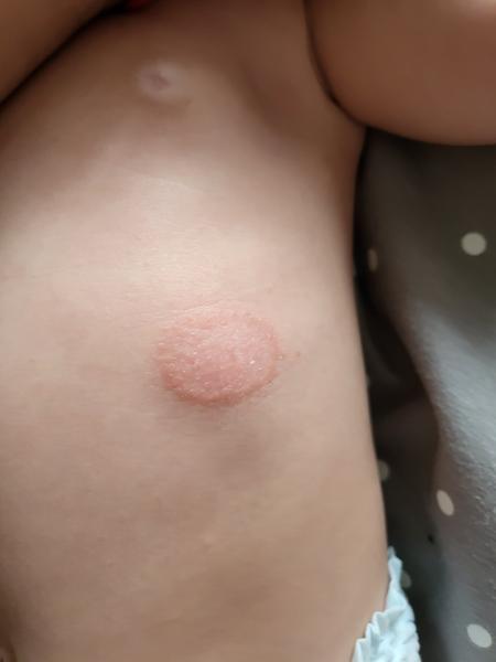 Fliačik u bábätka