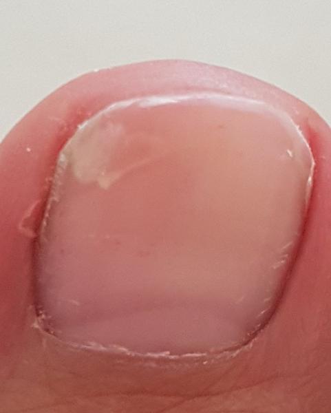 Ide o mykózu nechta?