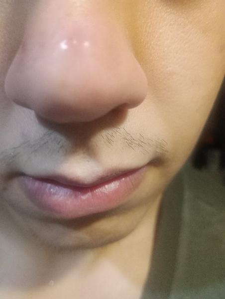 Ako sa zbaviť tvrdohlavých vyrážok na nose?