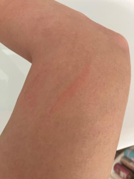 Svrbenie tela v 14. týždni tehotenstva: Čo robiť?