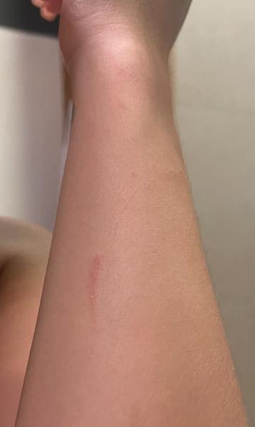 Je dôvod na obavu z besnoty po uhryznutí psom?