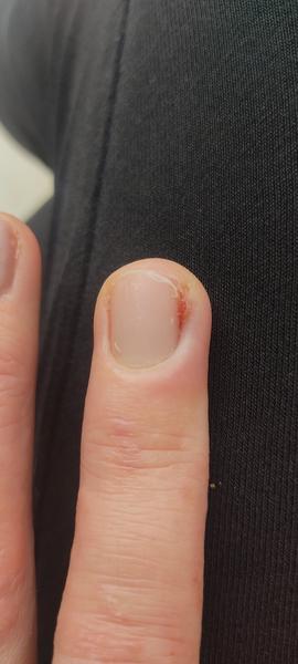 Ako liečiť zápal nechtového lôžka?