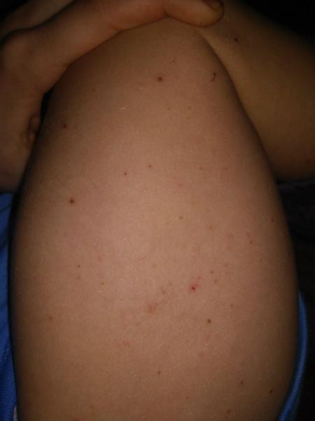 Čo sú toto za vyrážky?