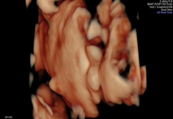 Čakám chlapca alebo dievča?