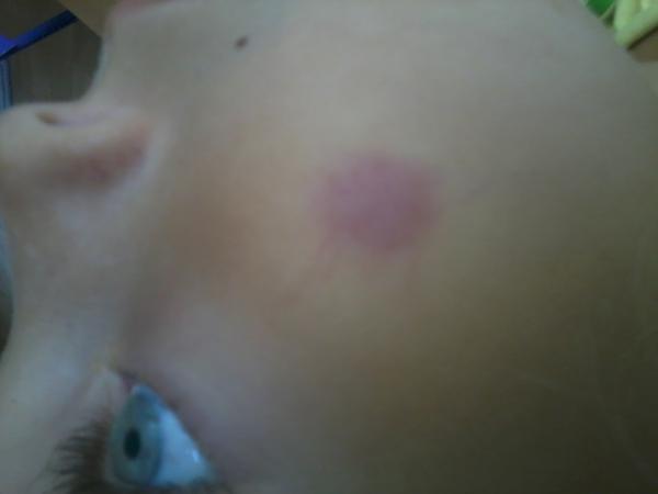 Zvláštna vyrážka na líci