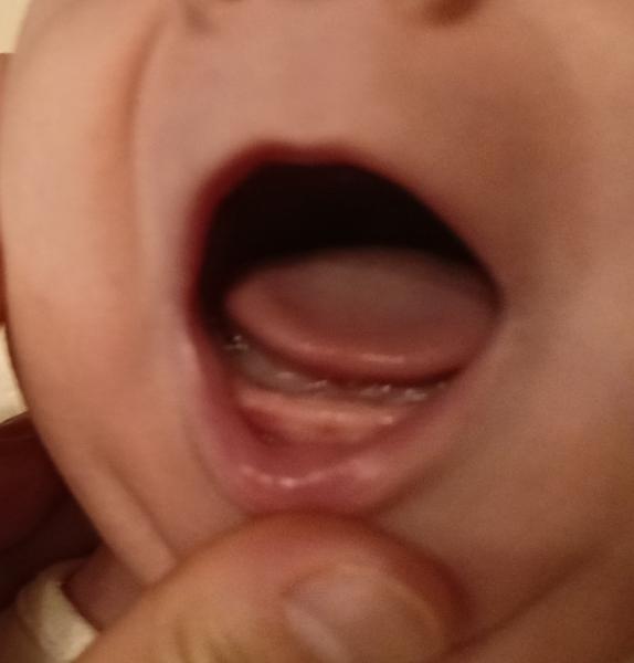 Môže prerezávanie zúbkov spôsobovať problémy?