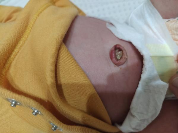 Odpadnutý pupočník