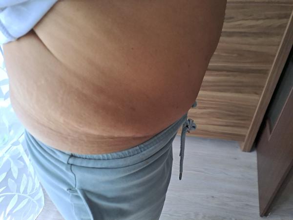 Dá sa upraviť moje brucho?