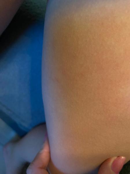 Čo je príčinou vyrážok a kožných problémov u dcérky?