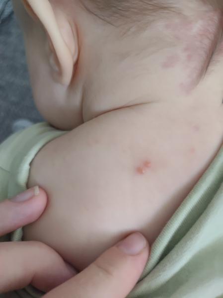 Pupáčiky na chrbte