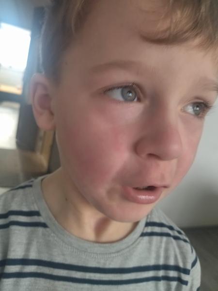 Červené fľaky na tvári. Piata choroba alebo niečo iné?