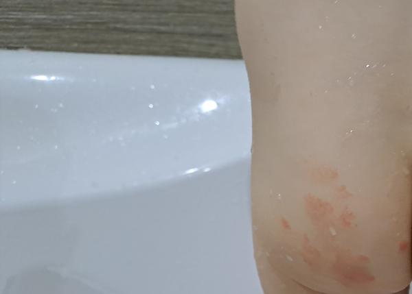 Ekzém u 2,5-ročnej dcérky