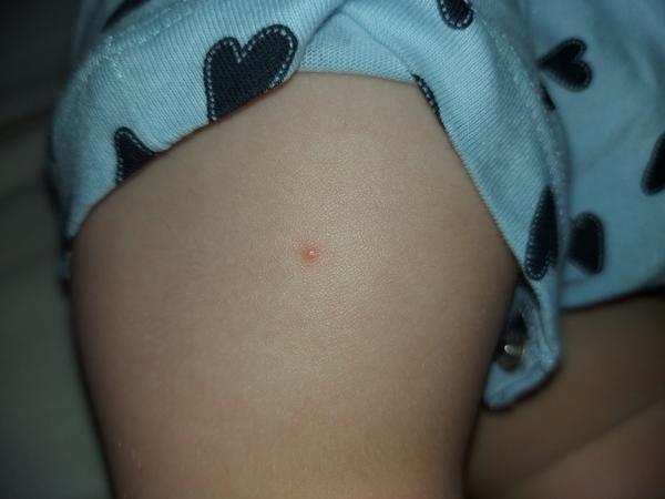 Má moja 14 mesačná dcérka molusky?