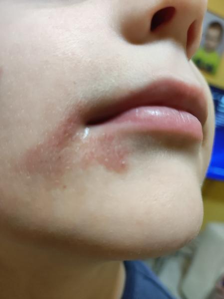 Čo môže spôsobiť červený fľak okolo úst u detí?