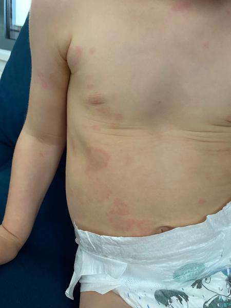 Aké červené fľaky má moje dvojročné dieťa na tele?