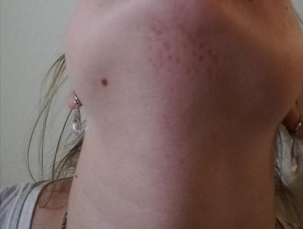 Aké fľaky to mám pod bradou?