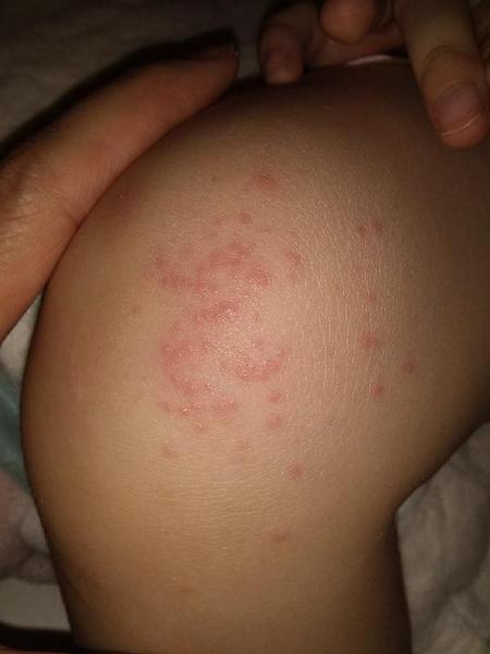 Vyrážky na kolene dieťaťa
