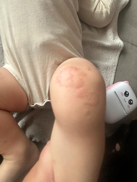 Je to žihľavka alebo niečo iné?