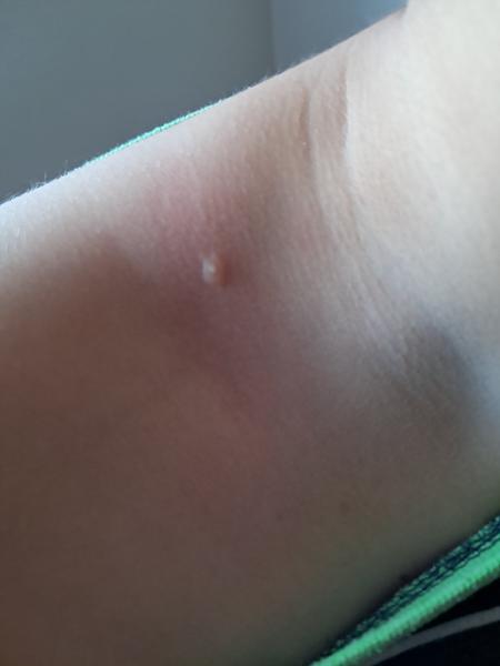 Čo spôsobuje vyrážku na pokožke?