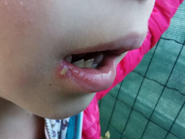 Je to herpes alebo iné ochorenie?