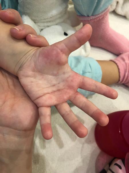 Vyrážky na dlaniach u 2-ročnej, čo to môže byť?