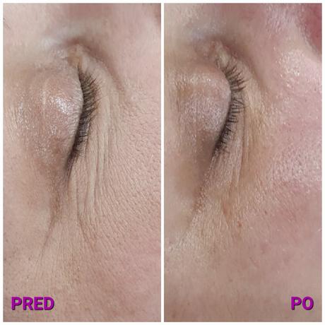 Radiothermolifting - omladenie rádiofrekvenciou, 