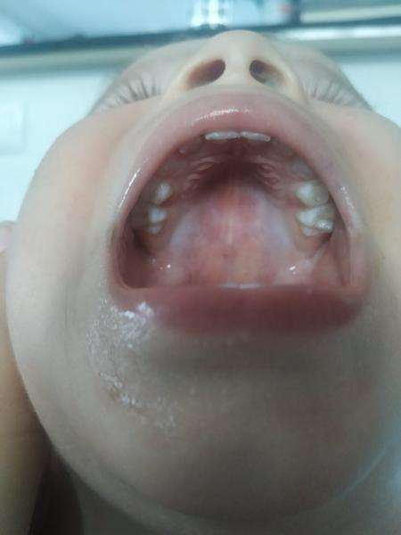 Aké fľaky má môj trojročný syn na podnebí?