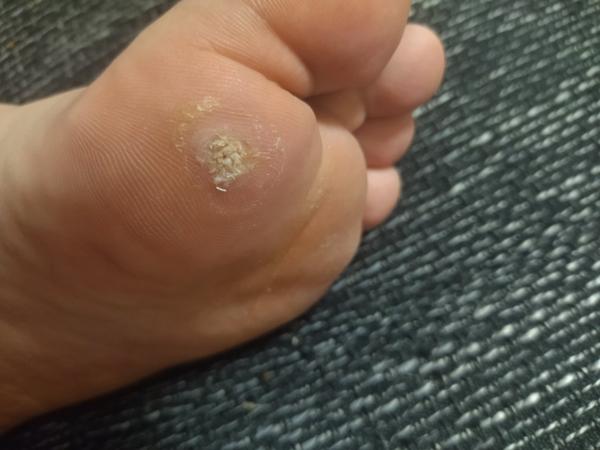 Je to kurie oko či bradavica?