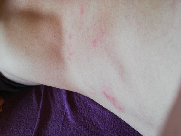 Aké vyrážky má moje dieťa?