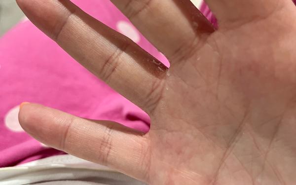 Čo spôsobuje šúpanie medzi prstami na rukách?