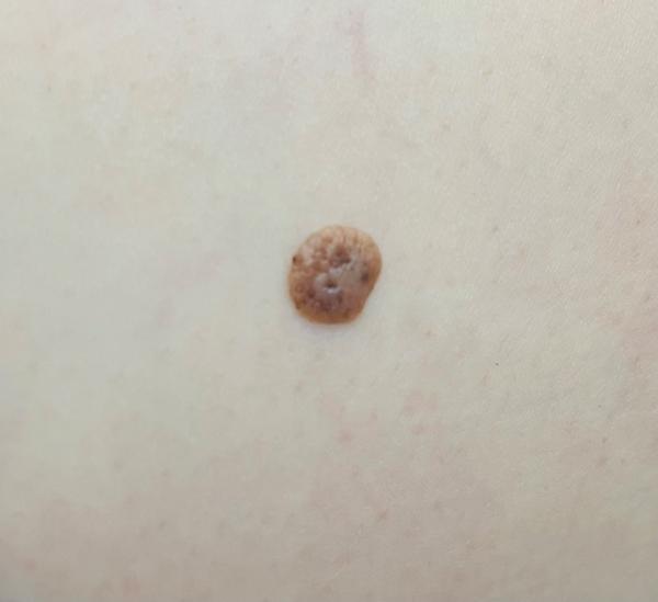 Je toto znamienko na nohe v poriadku?