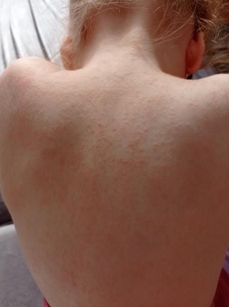 Kožné prejavy Covidu u detí