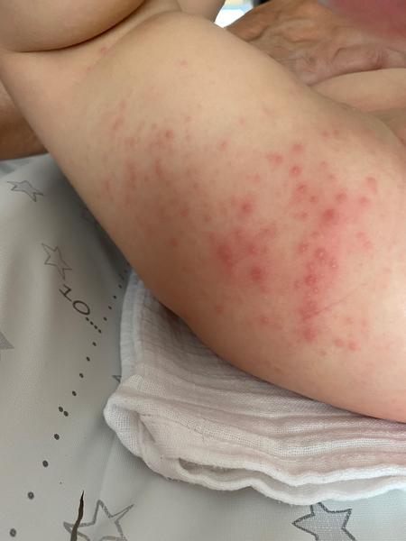 Čo znamenajú červené vyrážky na stehnách 17-mesačnej dcérky?
